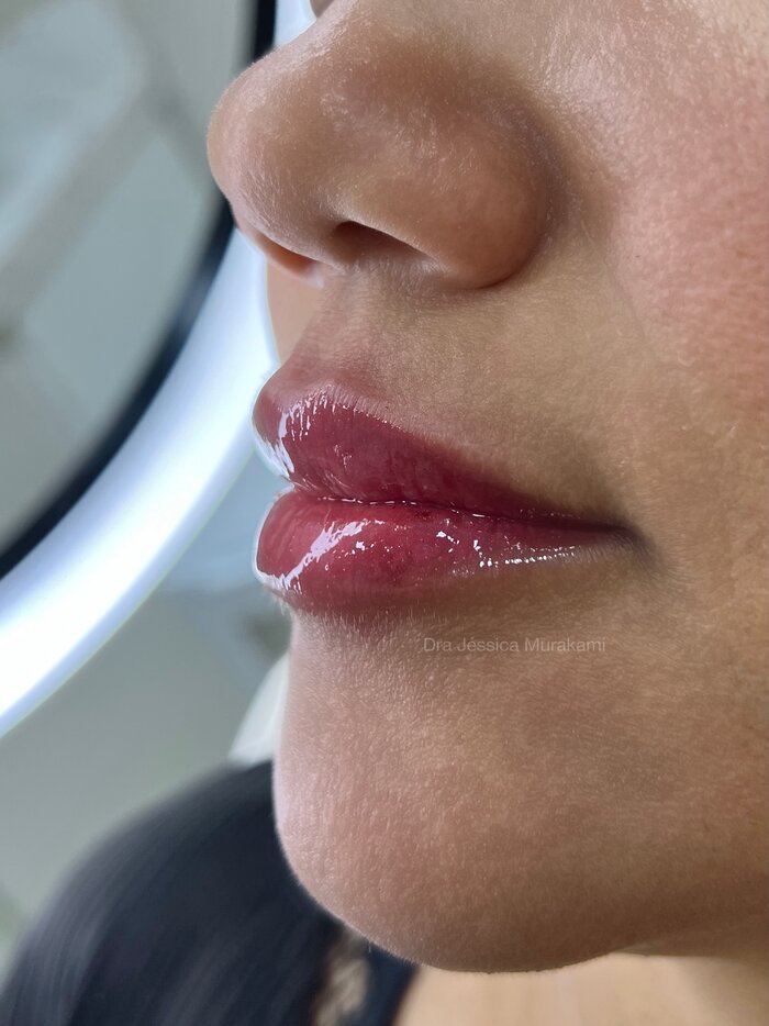 Resultado de harmonização orofacial