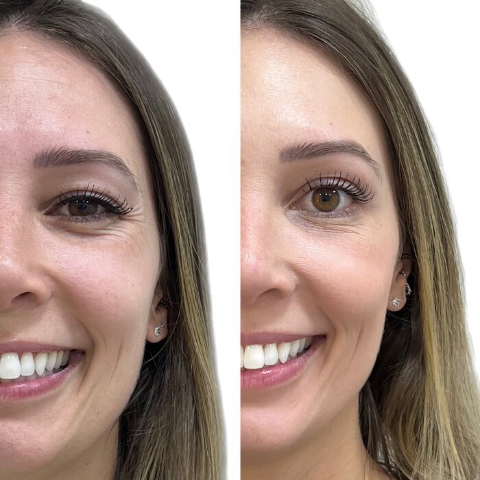 Antes e depois de harmonização orofacial