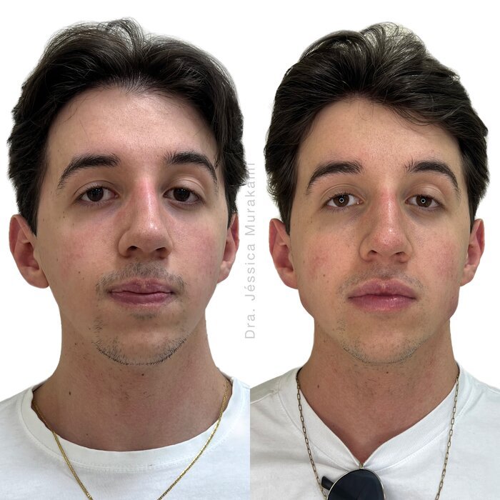 Antes e depois de harmonização orofacial